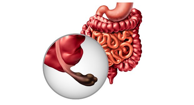 Appendix Surgery