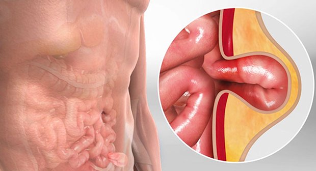 Hernia Surgery