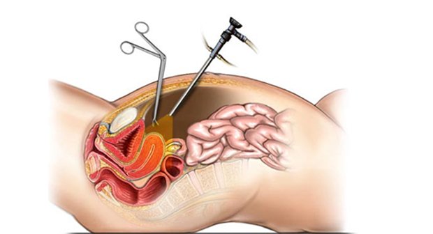 Hysterectomy